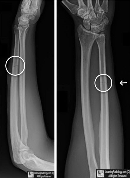 Nightstick Fracture